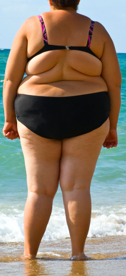 тело женщины с ожирением и запущенным целлюлитом